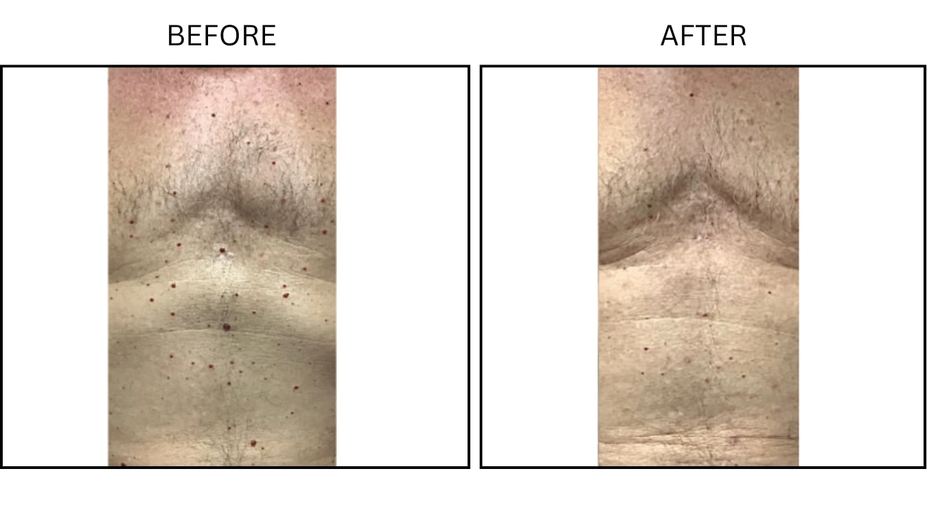 Cherry Angiomas (Medical), before and after photograph 1
