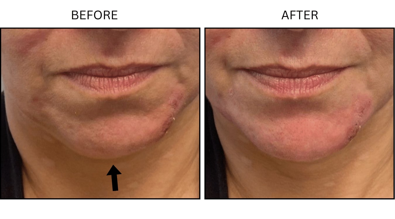 Chin (Fillers), before and after photograph 2