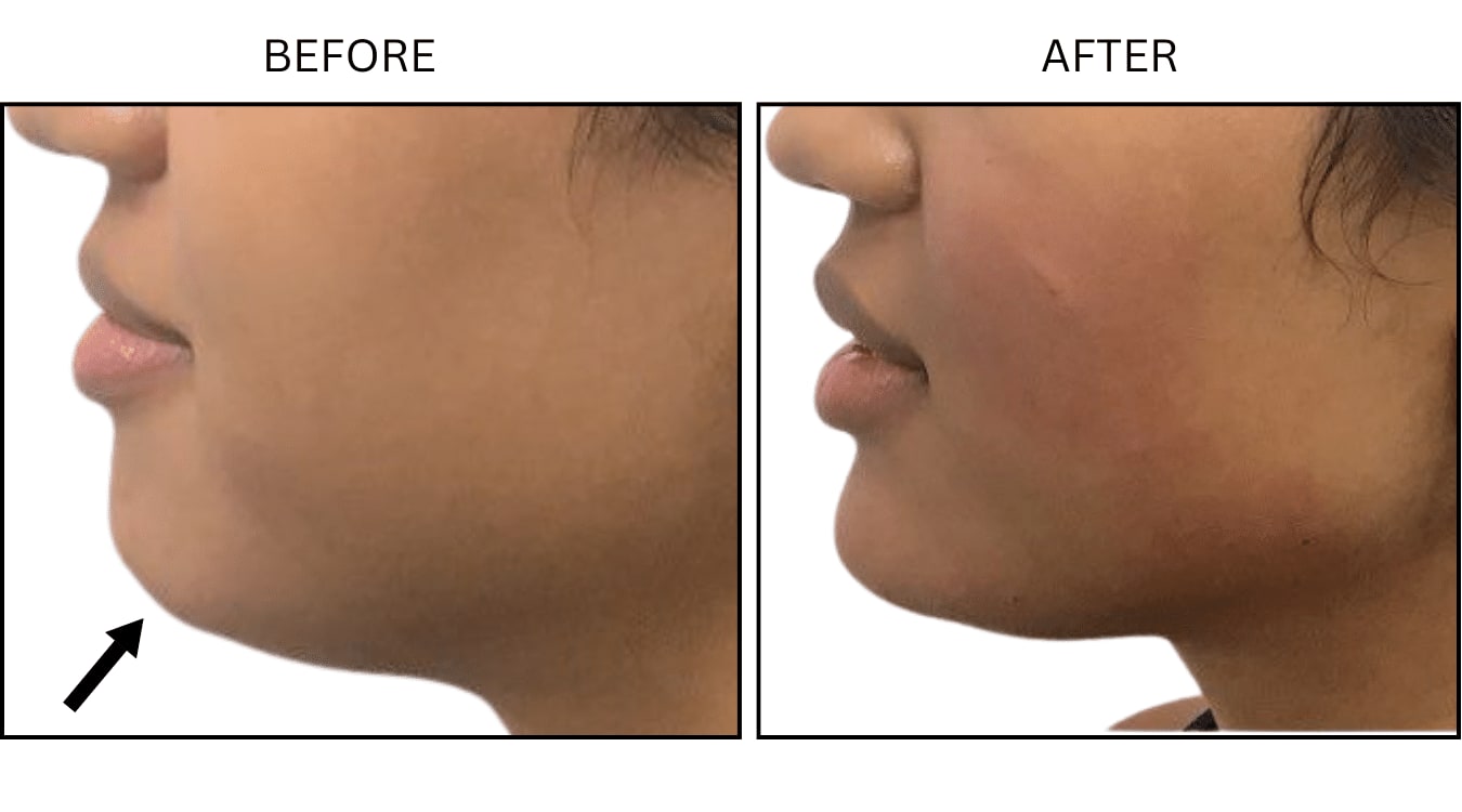 Chin (Fillers), before and after photograph 1