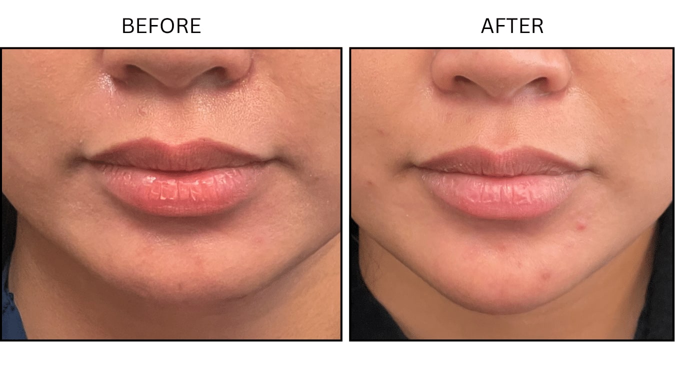 Chin (Neurotoxin Relaxers), before and after photograph 1