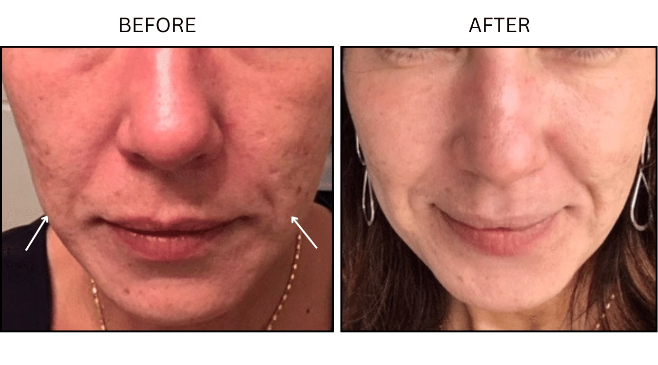 CO2 Laser (Lasers), before and after photograph 22
