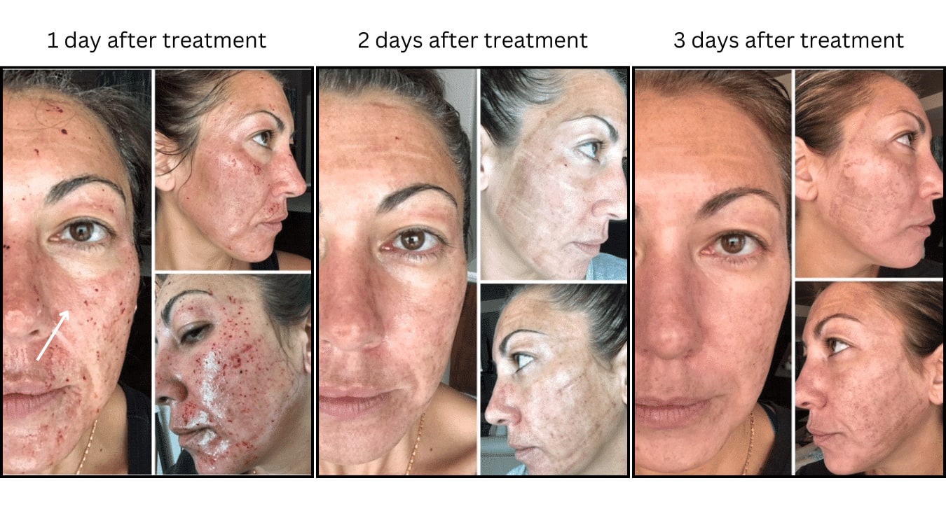 CO2 Laser (Lasers), before and after photograph 23