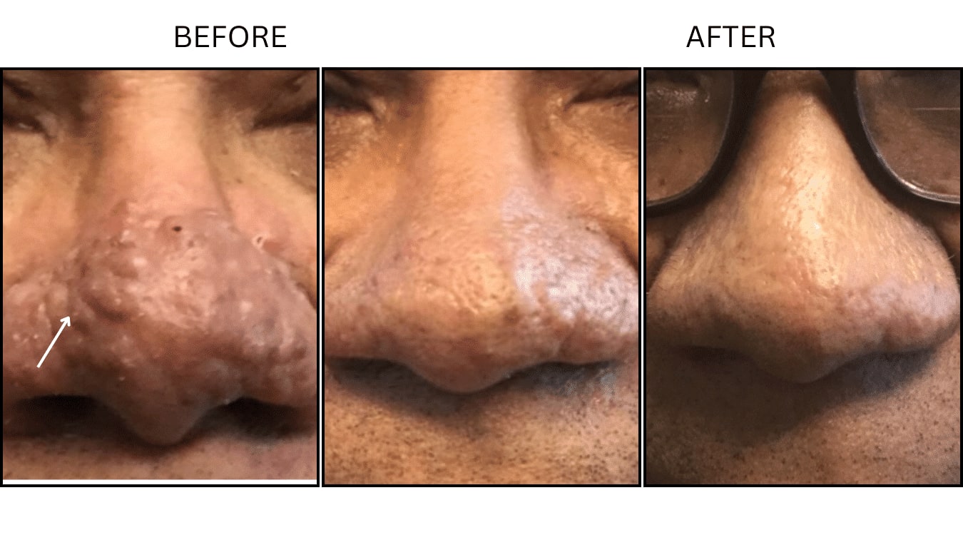 CO2 Laser (Lasers), before and after photograph 24