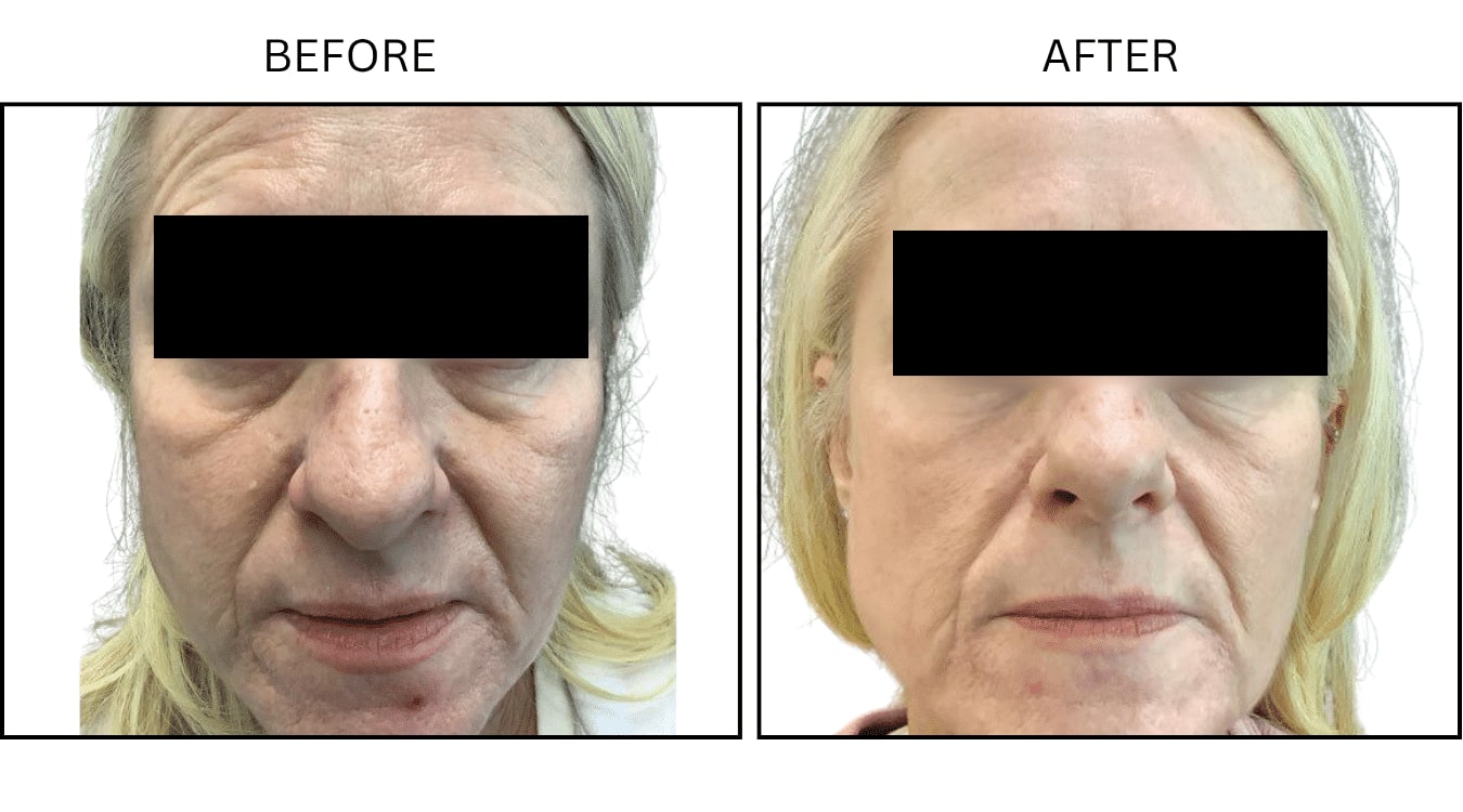 CO2 Laser (Lasers), before and after photograph 12