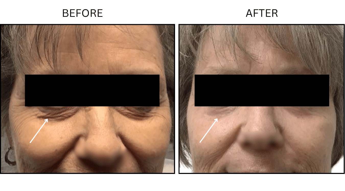 CO2 Laser (Lasers), before and after photograph 14