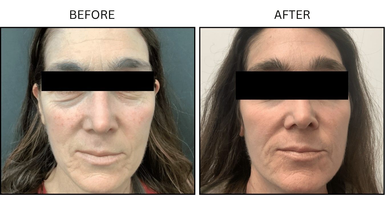 CO2 Laser (Lasers), before and after photograph 1