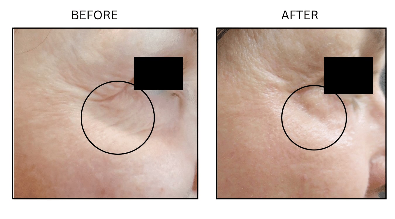 CO2 Laser (Lasers), before and after photograph 3