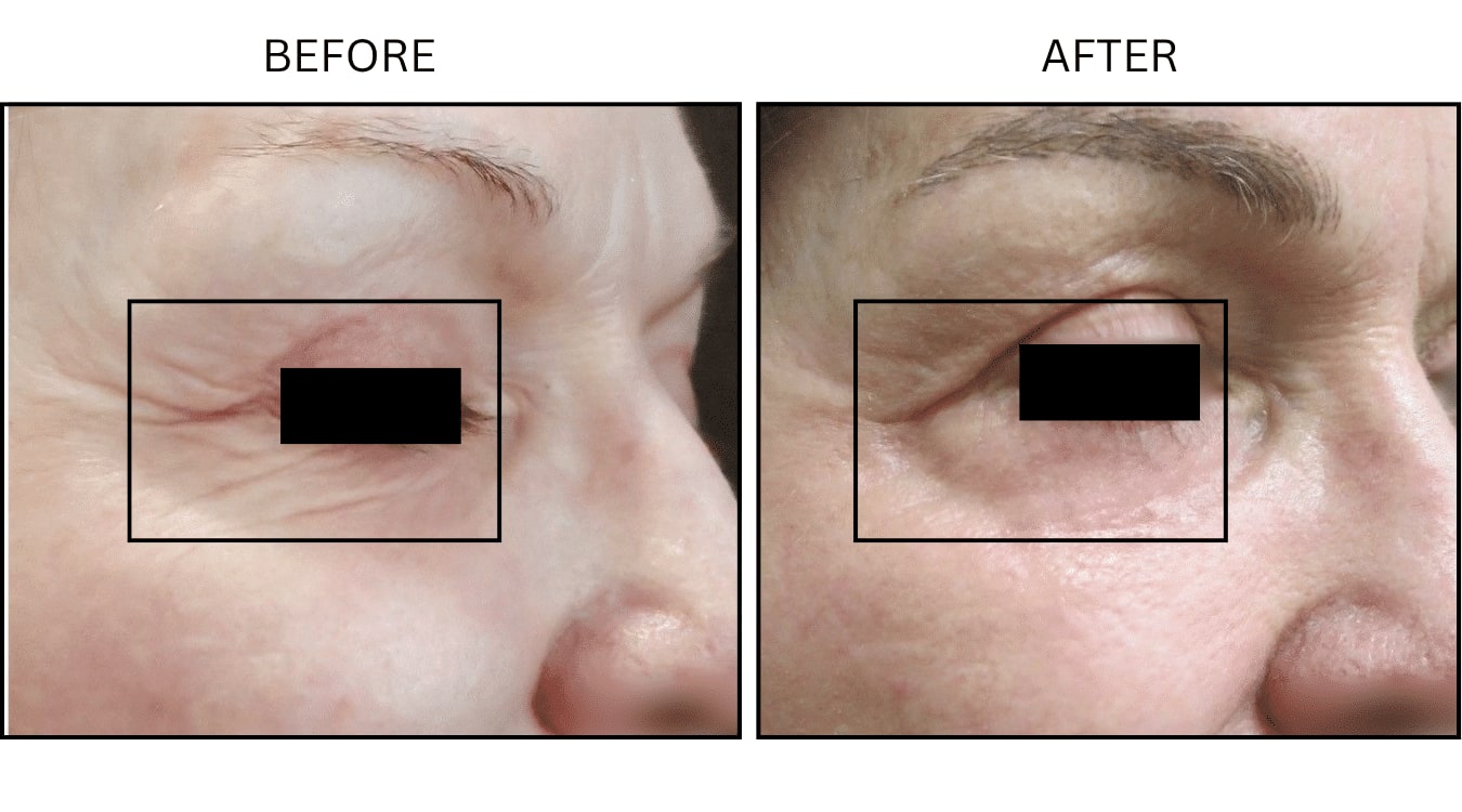 CO2 Laser (Lasers), before and after photograph 4