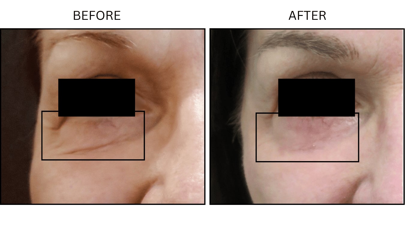 CO2 Laser (Lasers), before and after photograph 6