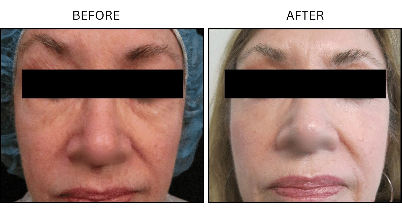 CO2 Laser (Lasers), before and after photograph 8