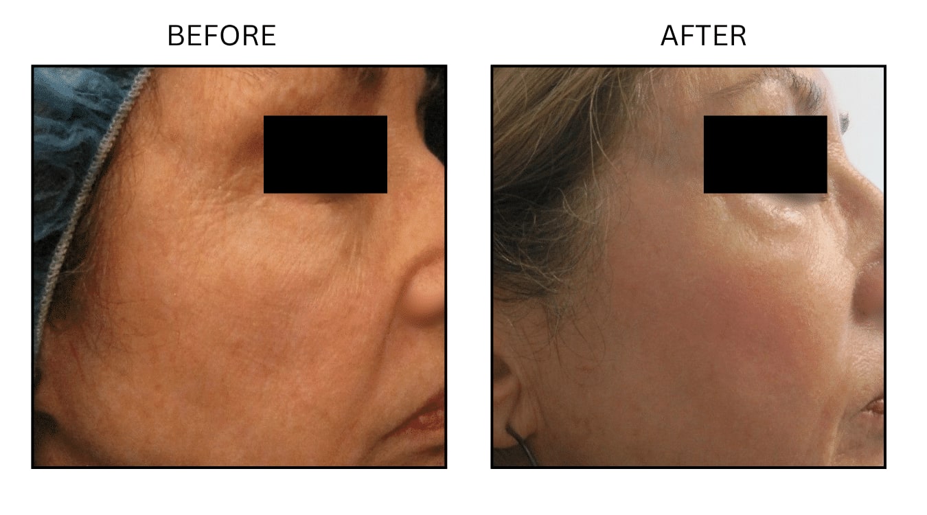 CO2 Laser (Lasers), before and after photograph 5