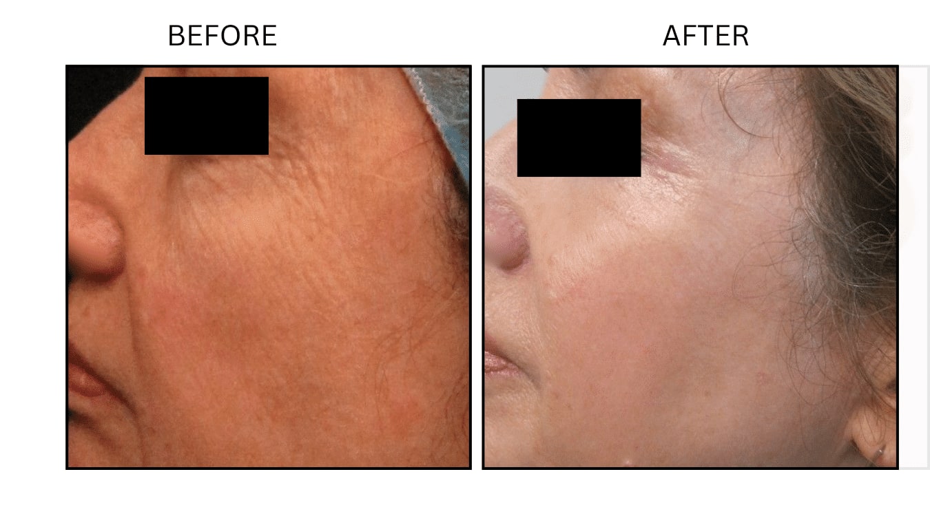 CO2 Laser (Lasers), before and after photograph 7