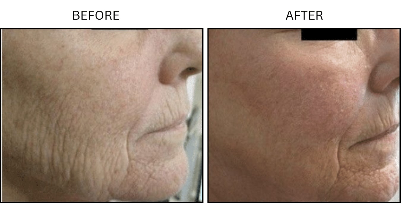 CO2 Laser (Lasers), before and after photograph 13