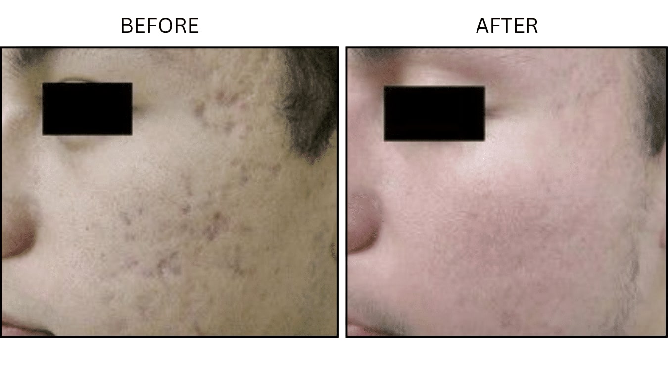 CO2 Laser (Lasers), before and after photograph 9