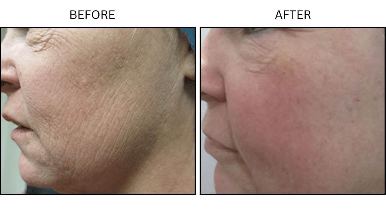 CO2 Laser (Lasers), before and after photograph 11
