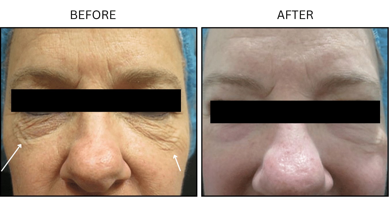 CO2 Laser (Lasers), before and after photograph 10