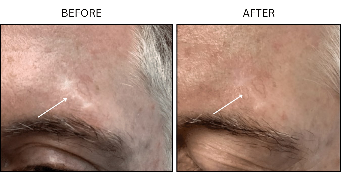 CO2 Laser (Lasers), before and after photograph 21