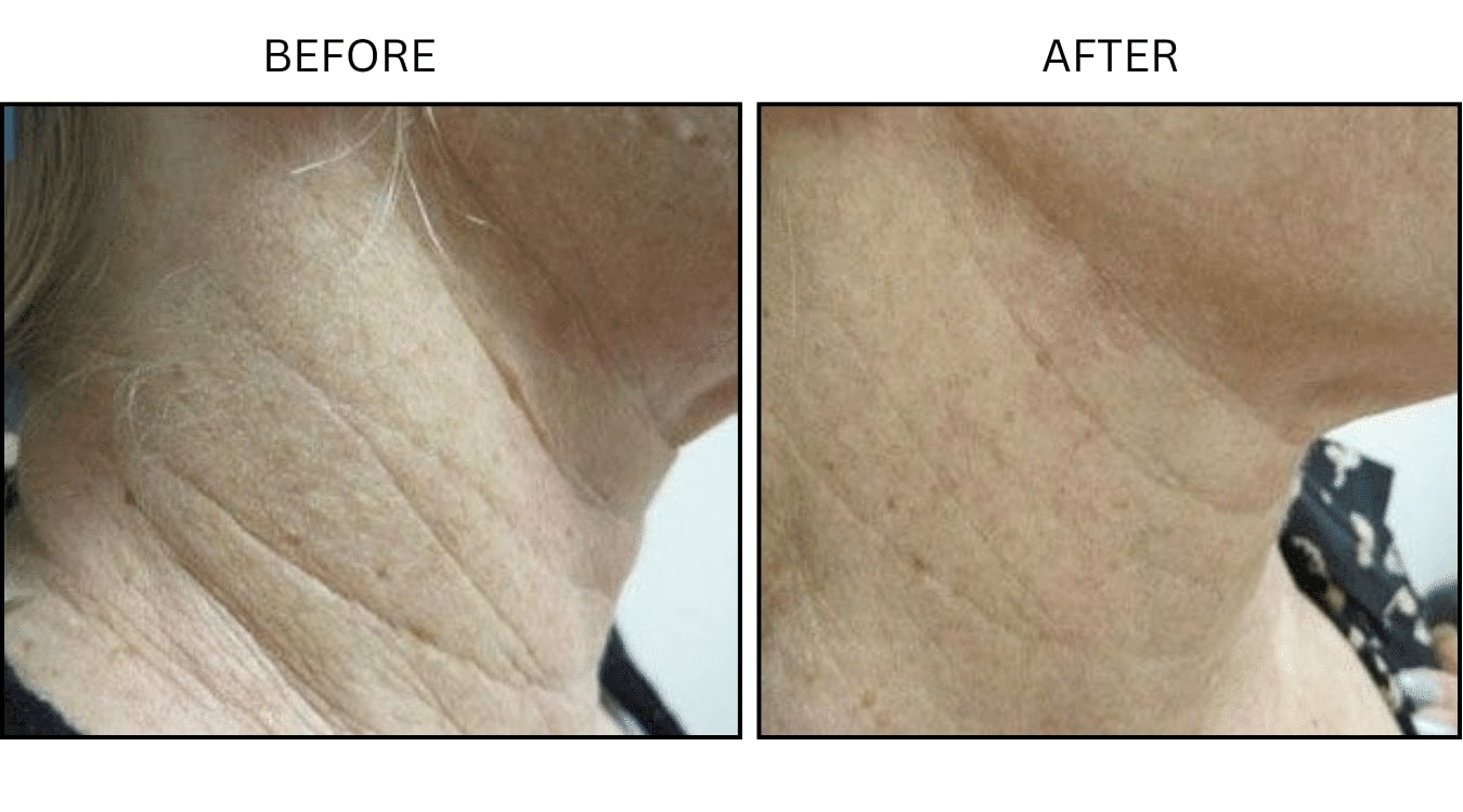 CO2 Laser (Lasers), before and after photograph 15
