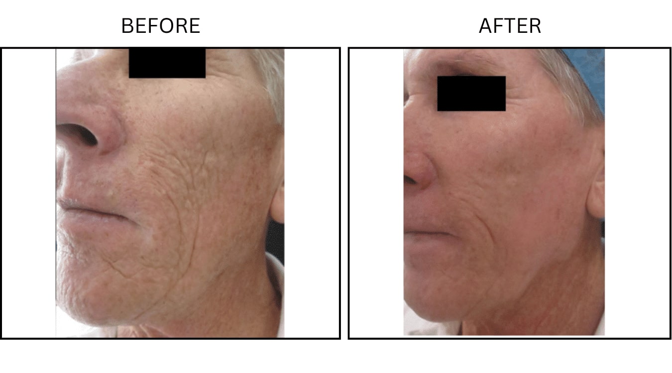 CO2 Laser (Lasers), before and after photograph 16