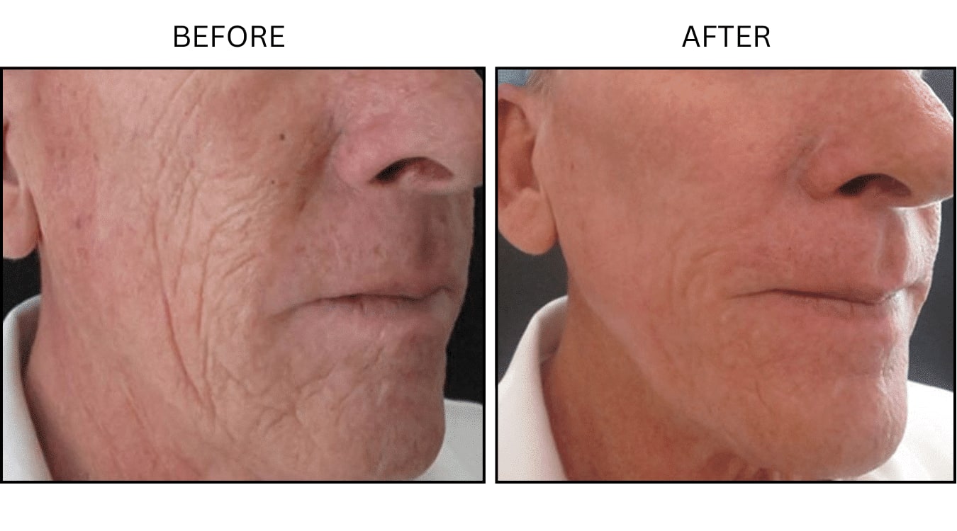 CO2 Laser (Lasers), before and after photograph 17