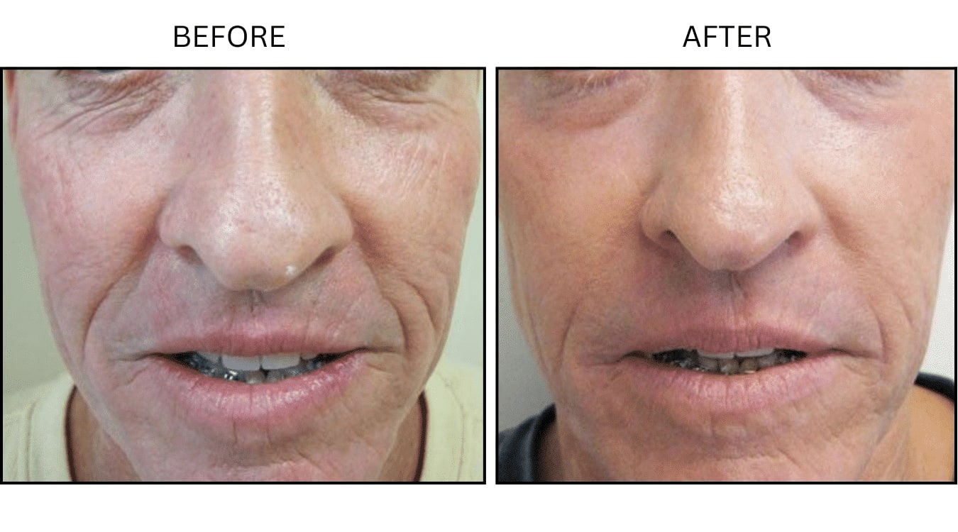 CO2 Laser (Lasers), before and after photograph 18