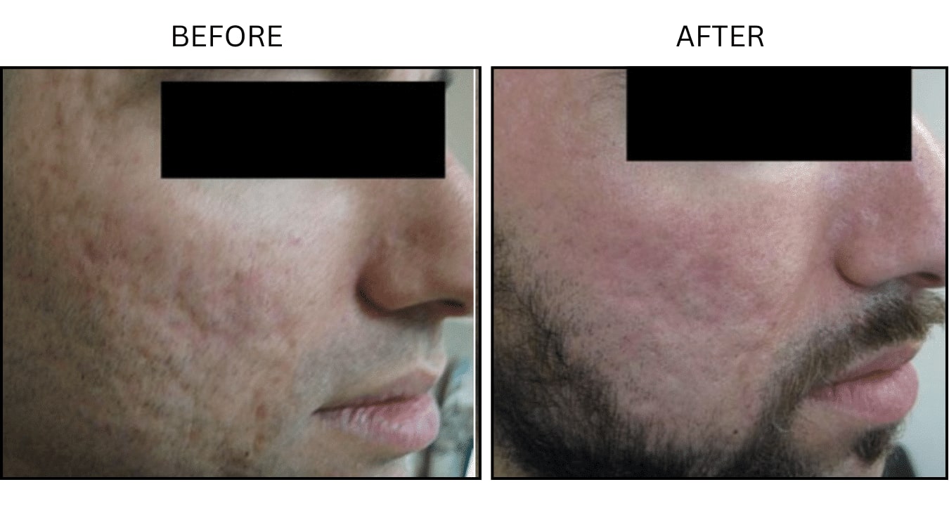 CO2 Laser (Lasers), before and after photograph 19