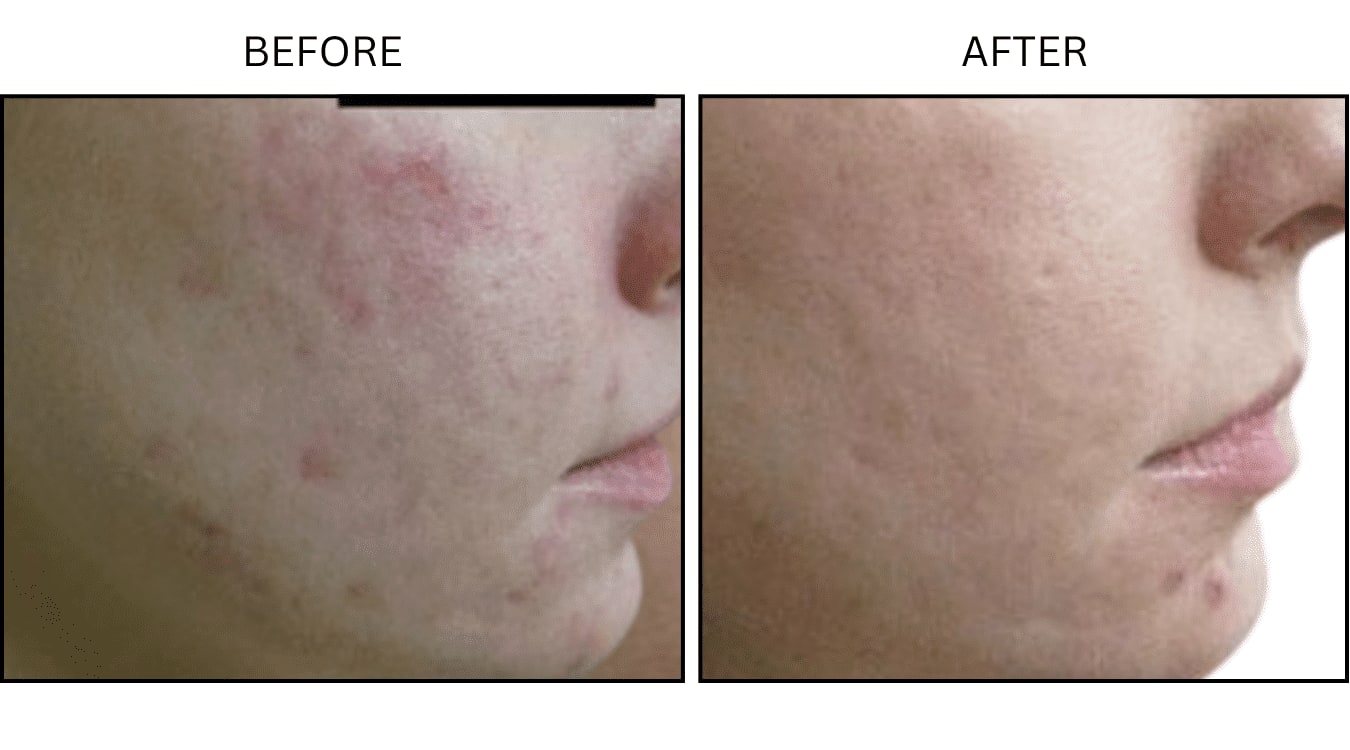 CO2 Laser (Lasers), before and after photograph 20
