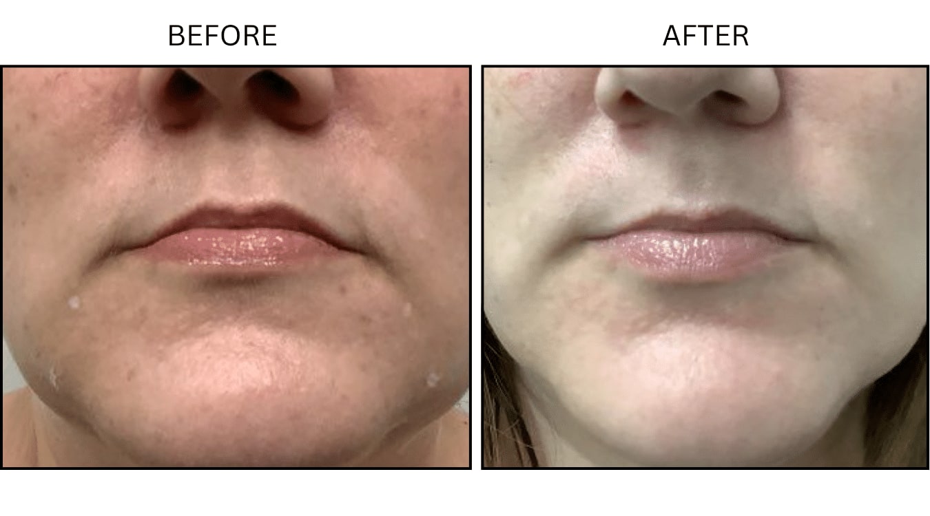 Corners Of Mouth (Neurotoxin Relaxers), before and after photograph 1