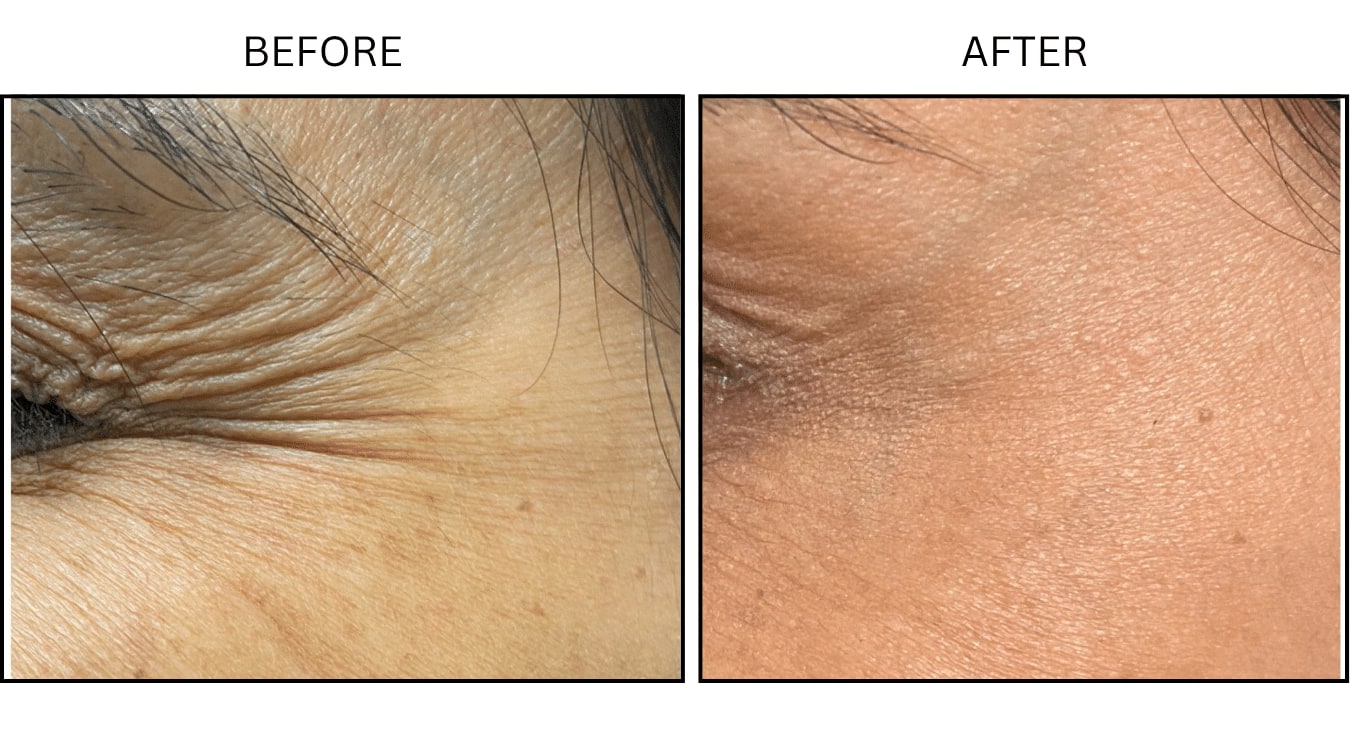 Crows Feet (Neurotoxin Relaxers), before and after photograph 1