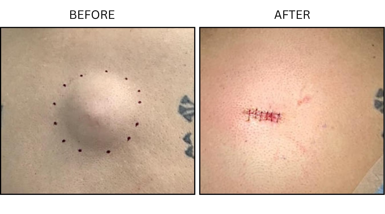 Cysts (Surgical (benign Destruction)), before and after photograph 1