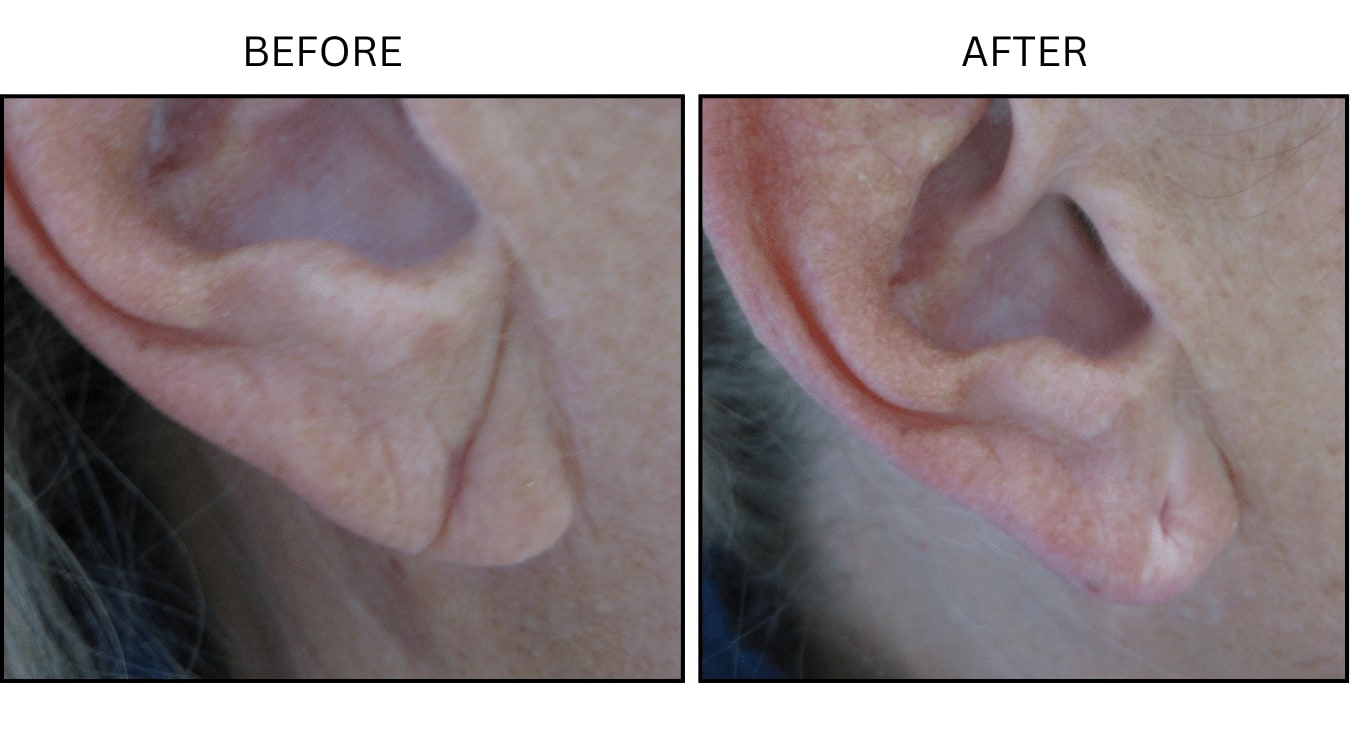 Earlobe (Fillers), before and after photograph 1