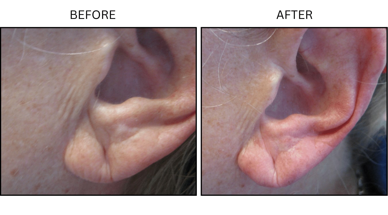 Earlobe (Fillers), before and after photograph 2