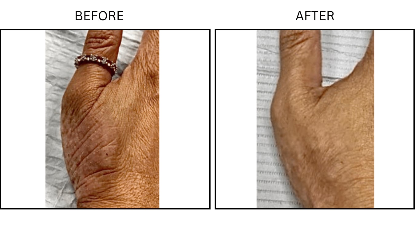 Eczema (Medical), before and after photograph 1