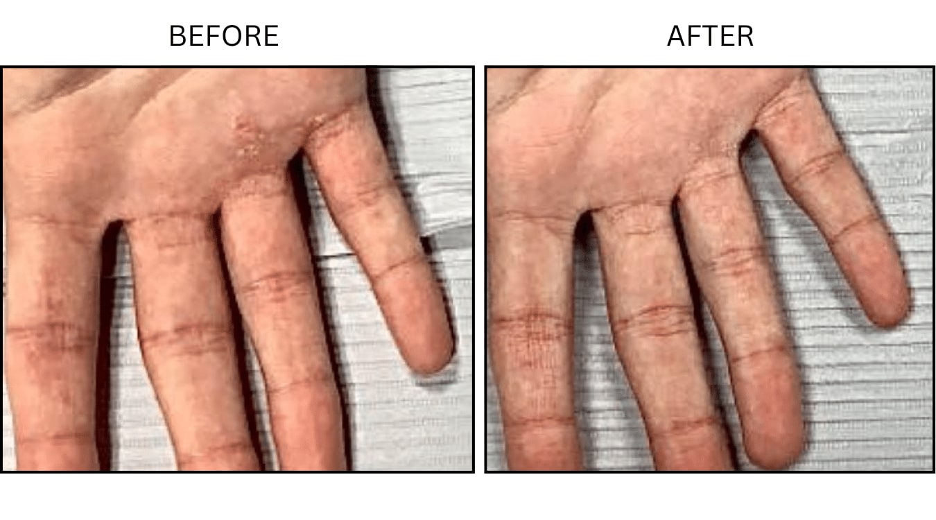 Eczema (Medical), before and after photograph 3