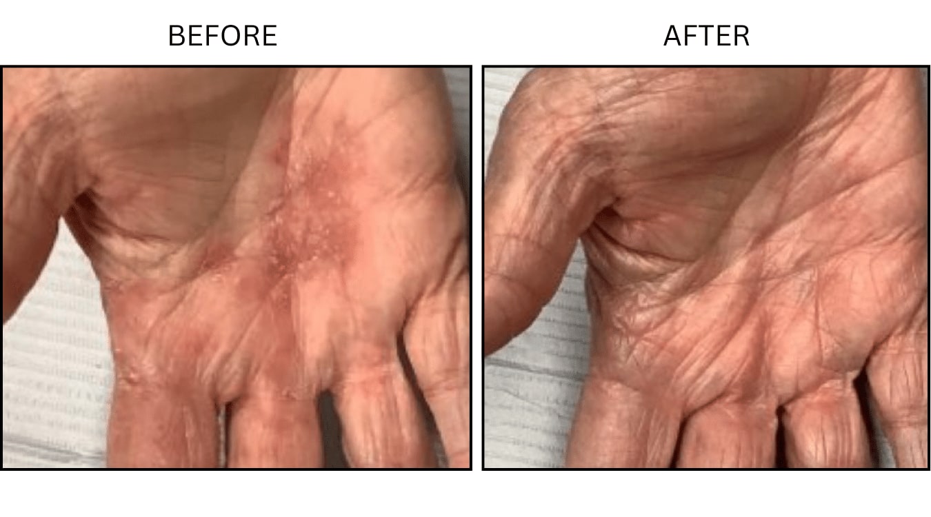 Eczema (Medical), before and after photograph 2