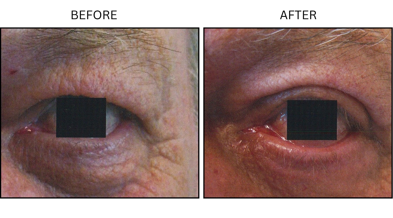 Eyelid Surgery (Surgical (benign Destruction)), before and after photograph 1