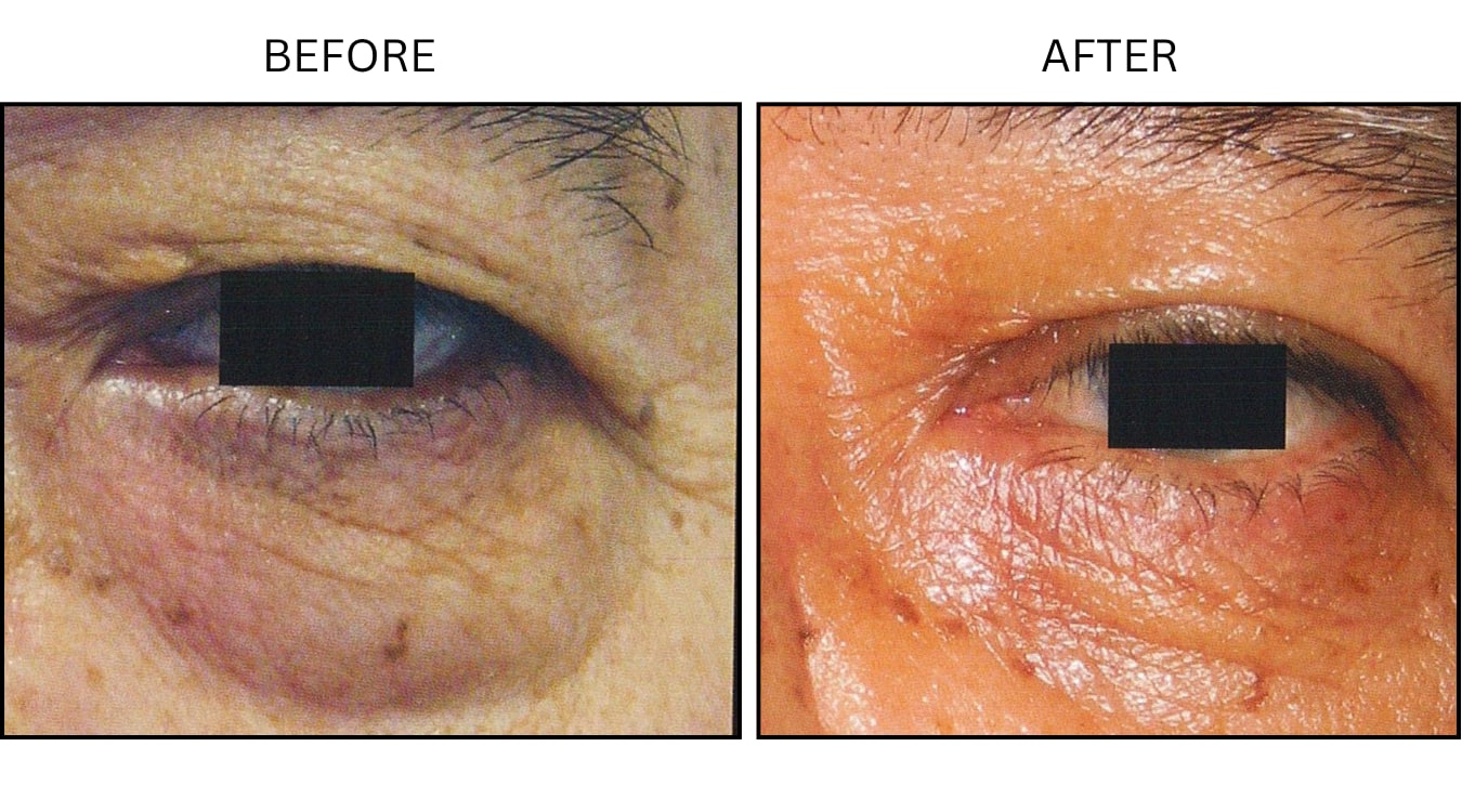 Eyelid Surgery (Surgical (benign Destruction)), before and after photograph 10