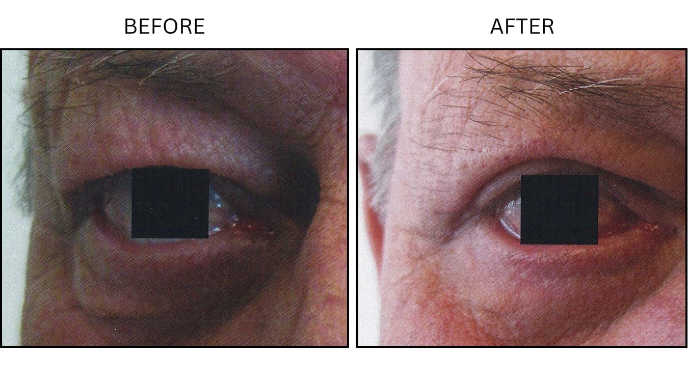 Eyelid Surgery (Surgical (benign Destruction)), before and after photograph 11