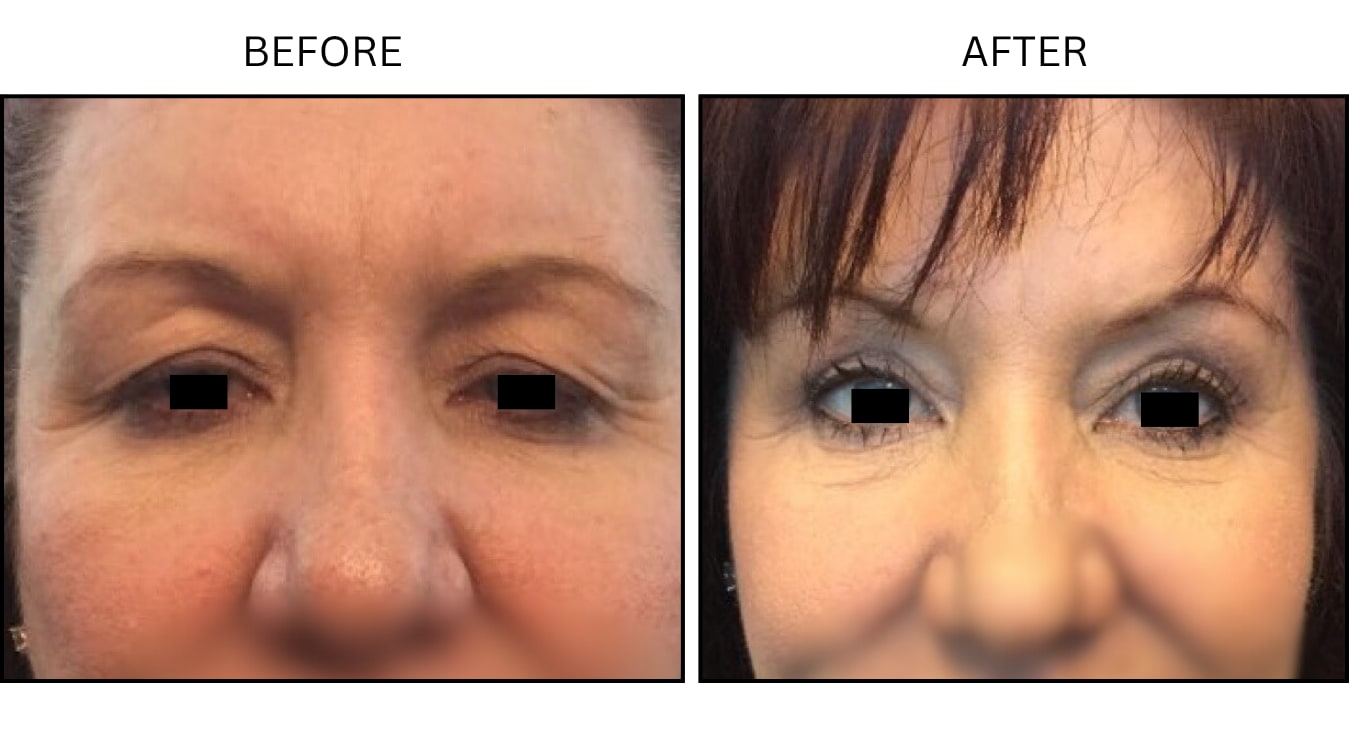 Eyelid Surgery (Surgical (benign Destruction)), before and after photograph 12