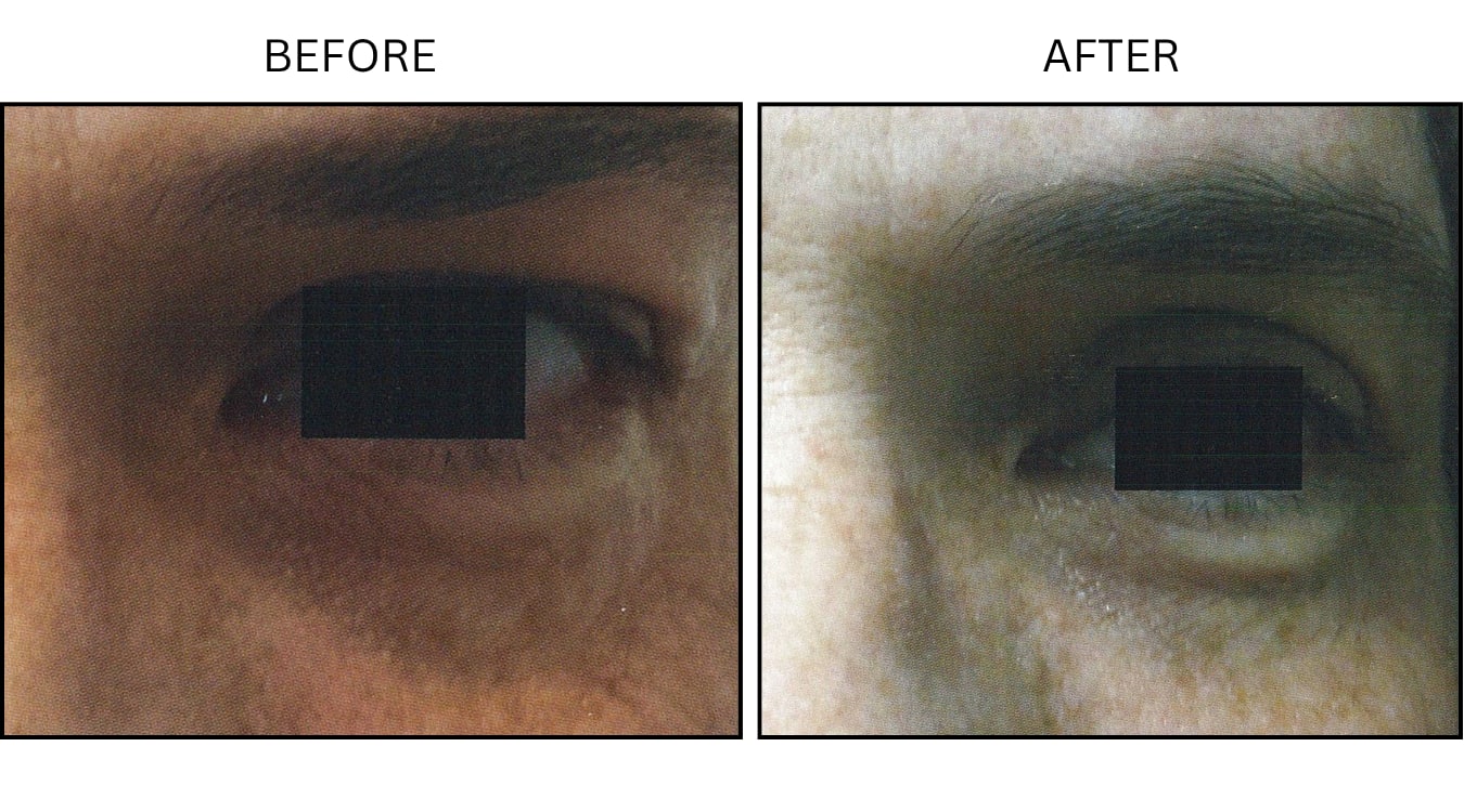 Eyelid Surgery (Surgical (benign Destruction)), before and after photograph 2