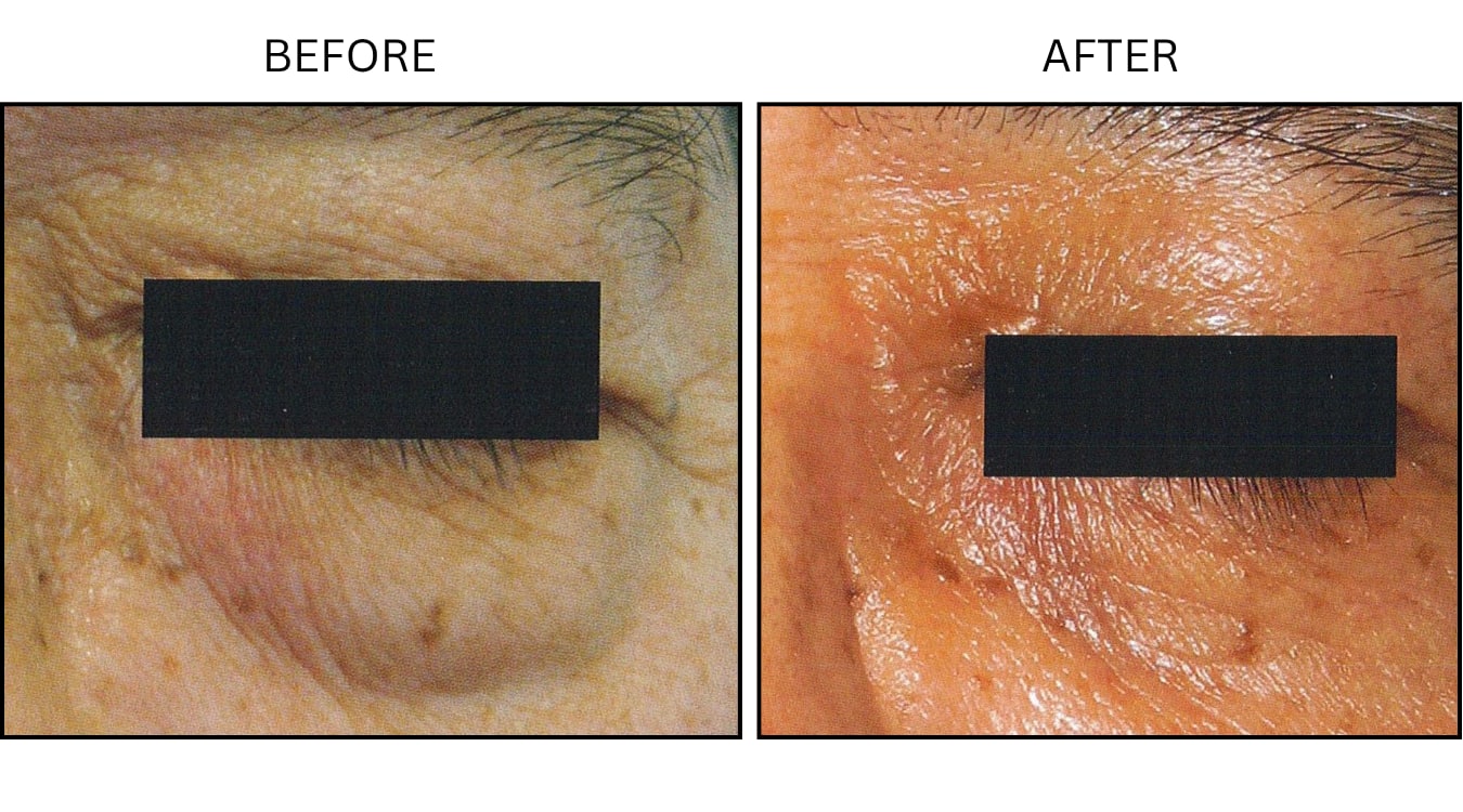 Eyelid Surgery (Surgical (benign Destruction)), before and after photograph 3