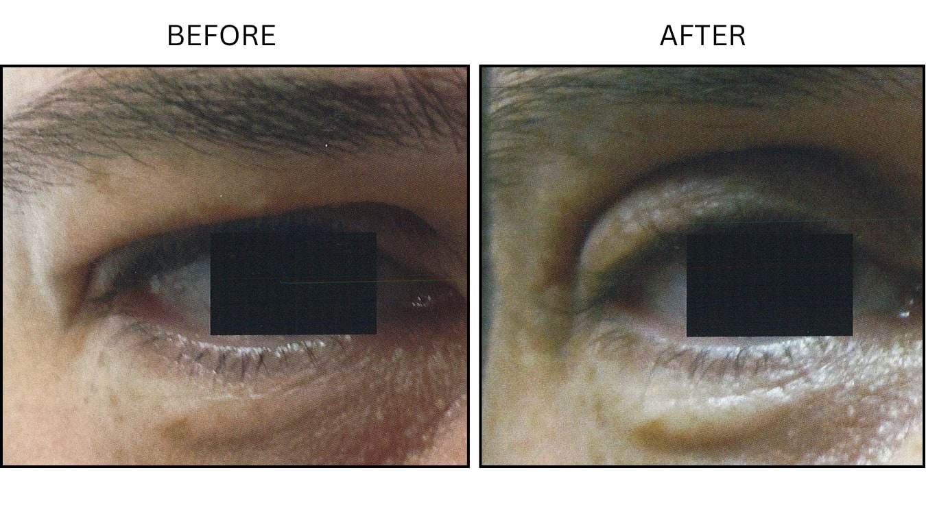 Eyelid Surgery (Surgical (benign Destruction)), before and after photograph 4