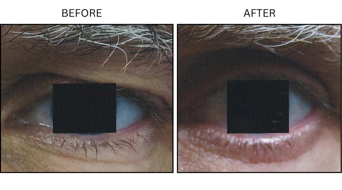 Eyelid Surgery (Surgical (benign Destruction)), before and after photograph 5