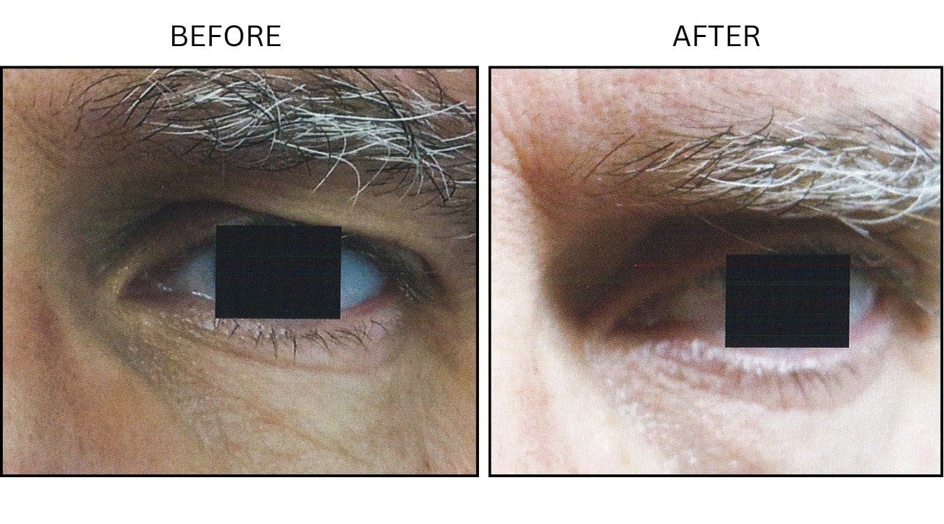 Eyelid Surgery (Surgical (benign Destruction)), before and after photograph 6