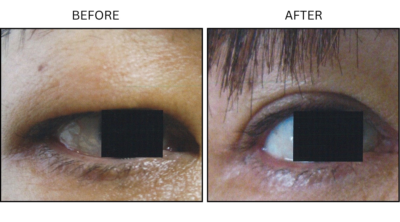 Eyelid Surgery (Surgical (benign Destruction)), before and after photograph 7