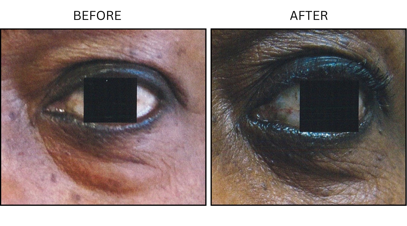 Eyelid Surgery (Surgical (benign Destruction)), before and after photograph 8