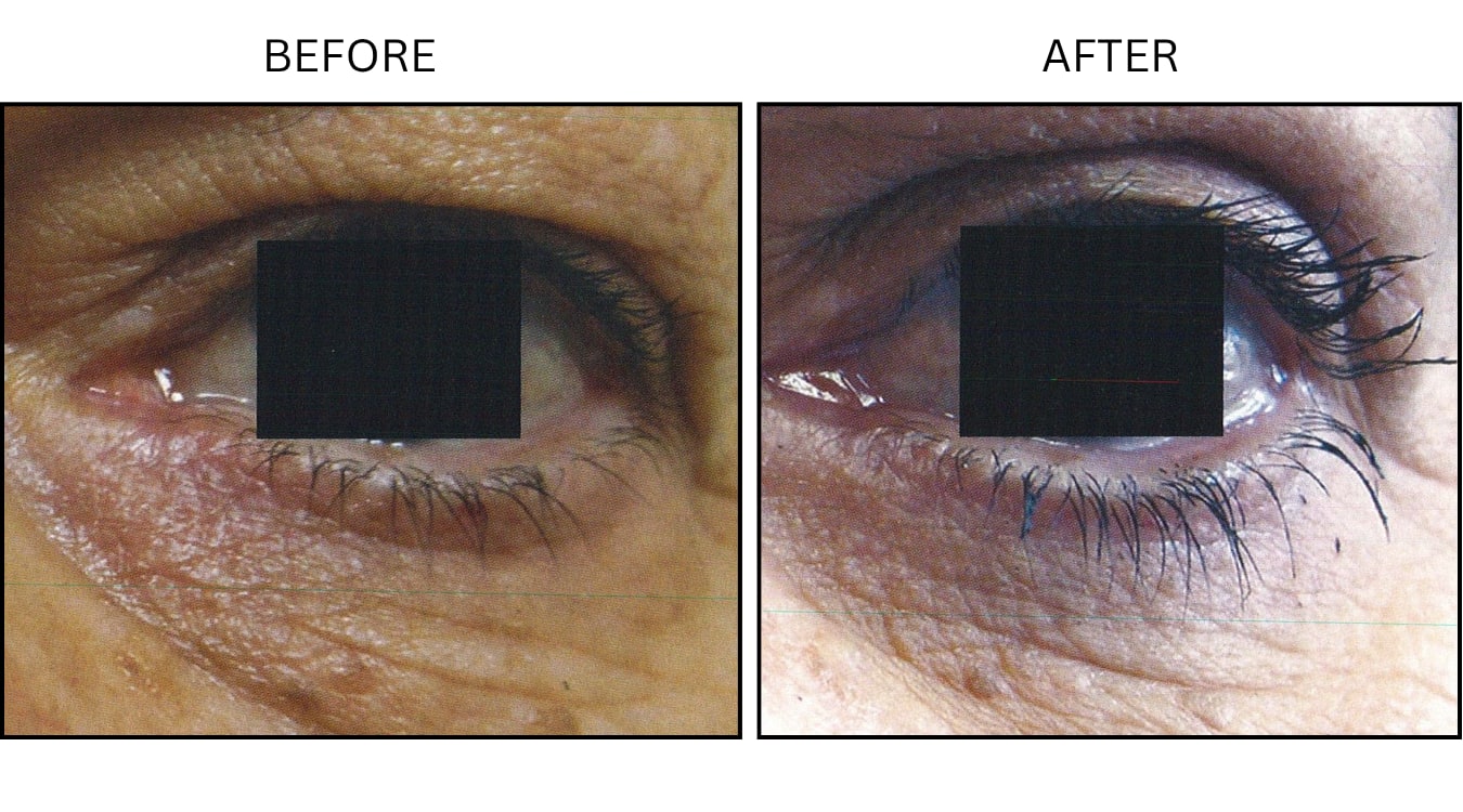 Eyelid Surgery (Surgical (benign Destruction)), before and after photograph 9