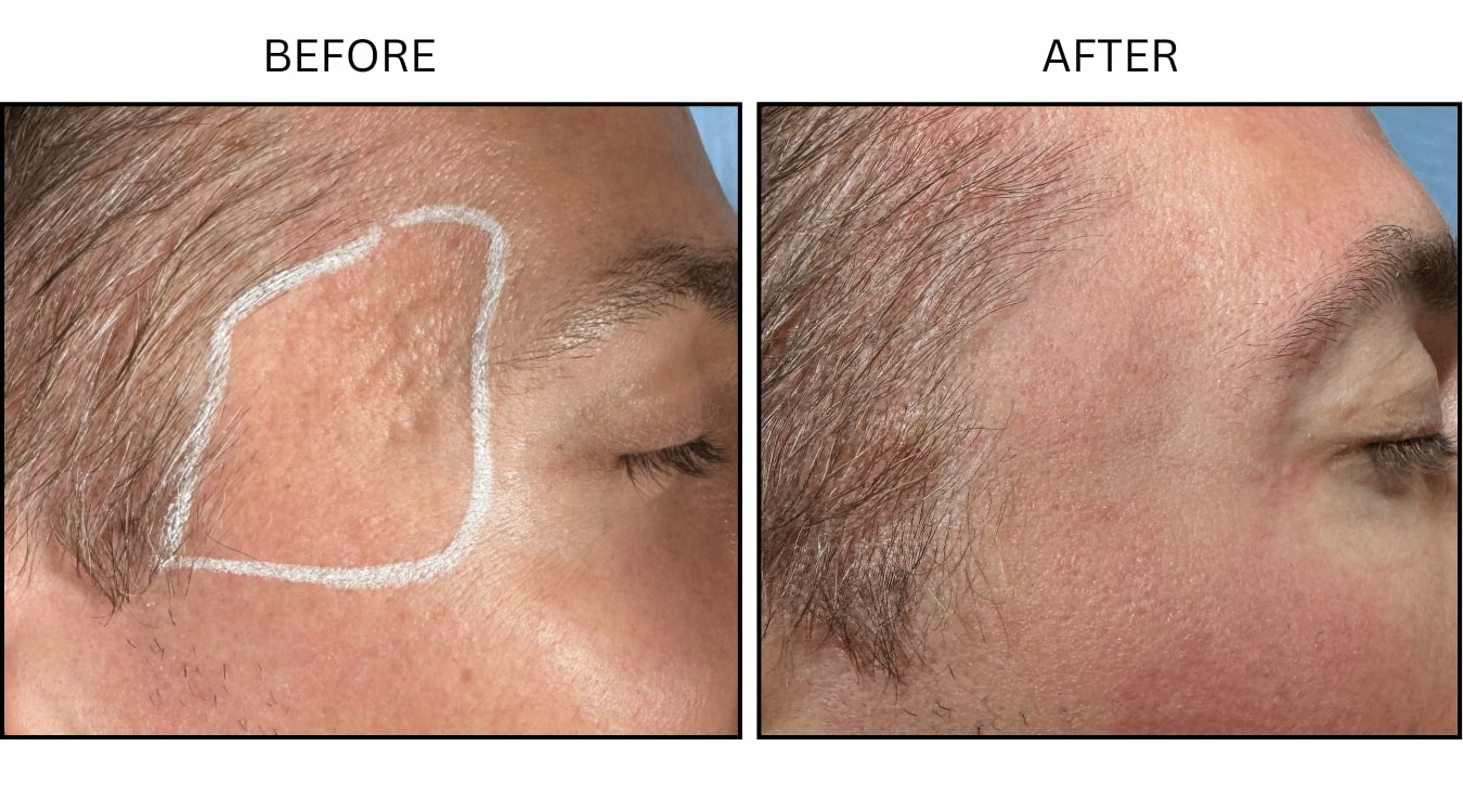 Fraxel (Lasers), before and after photograph 4