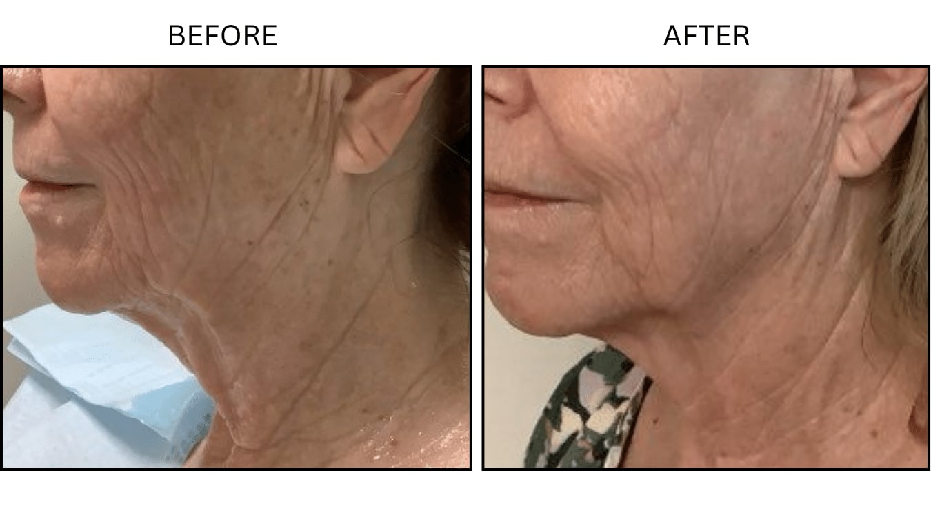 Fraxel (Lasers), before and after photograph 2