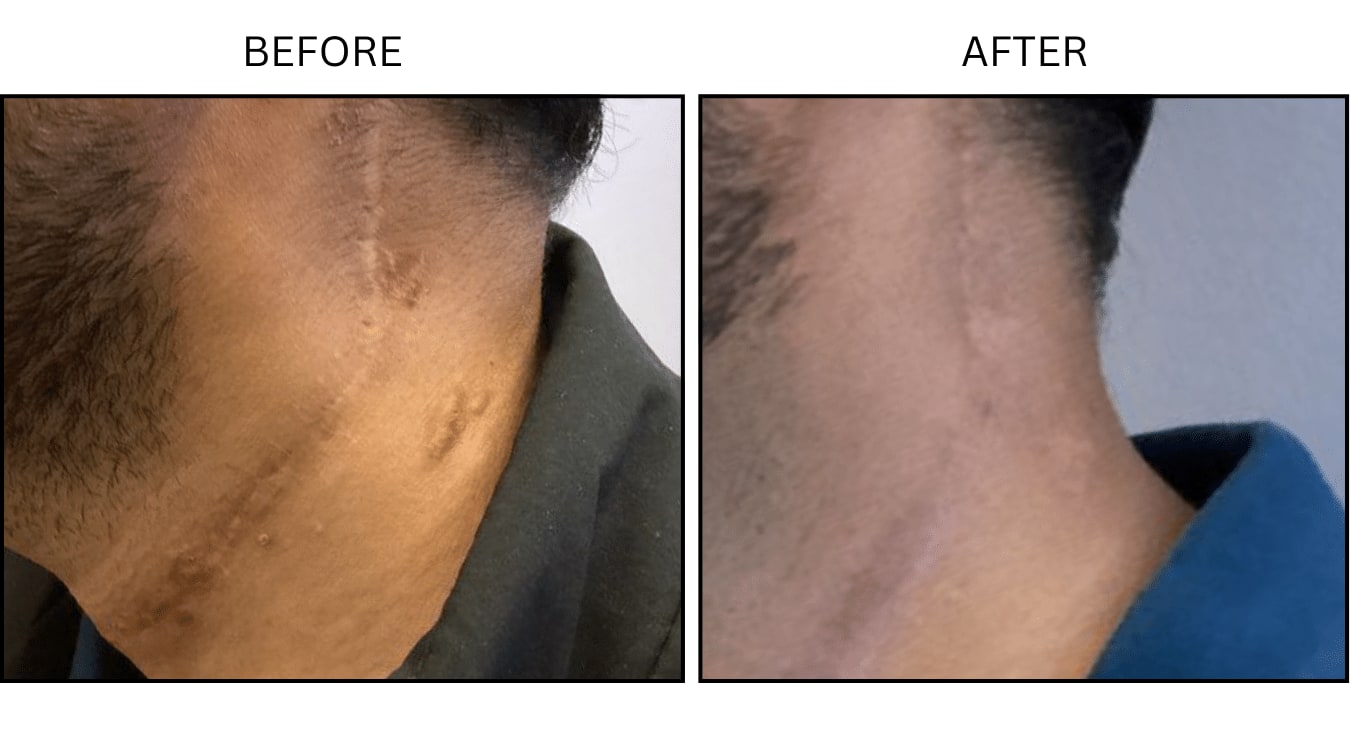 Fraxel (Lasers), before and after photograph 3